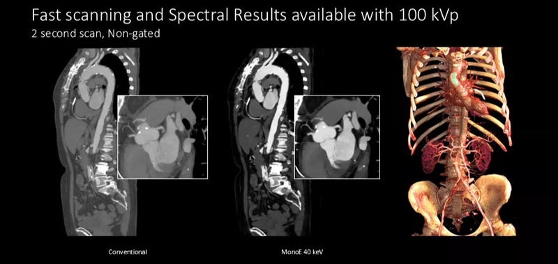 Система компьютерной томографии Philips Spectral CT 7500